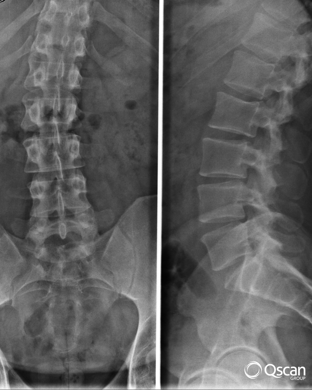 Long-length x-ray Qscan Group