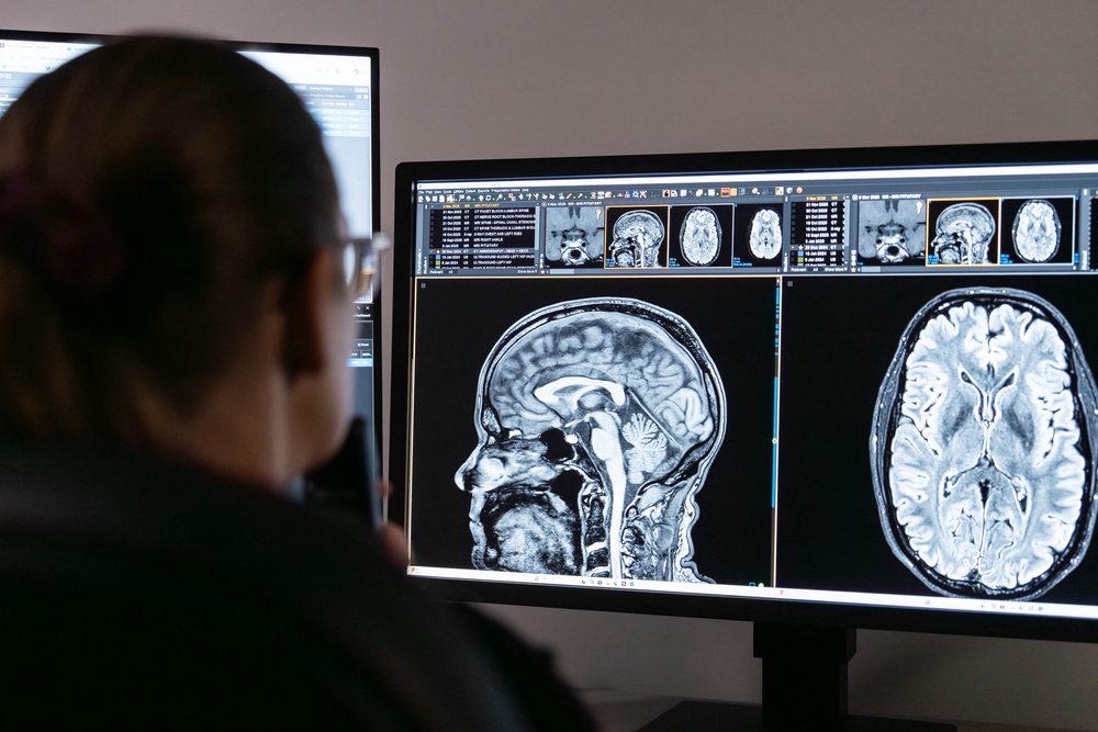 Radiologist reviewing brain MRI scans on dual monitors, with sagittal and axial views displayed.