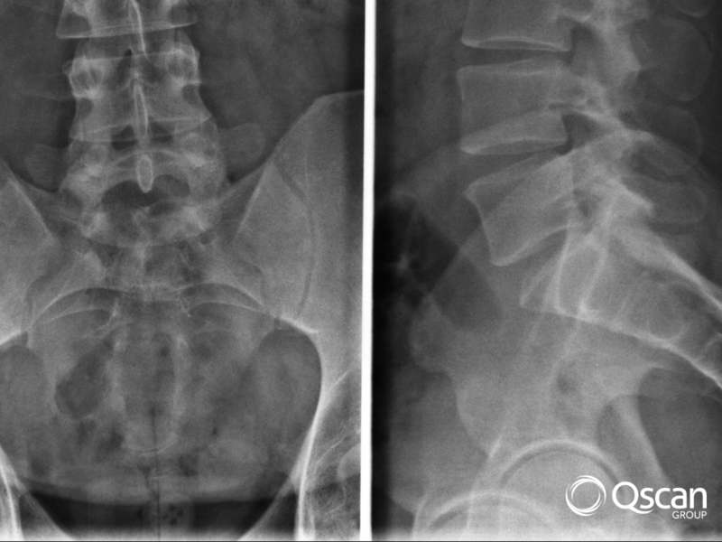 Spine back x-ray Qscan